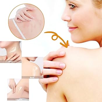 What is Eczema?