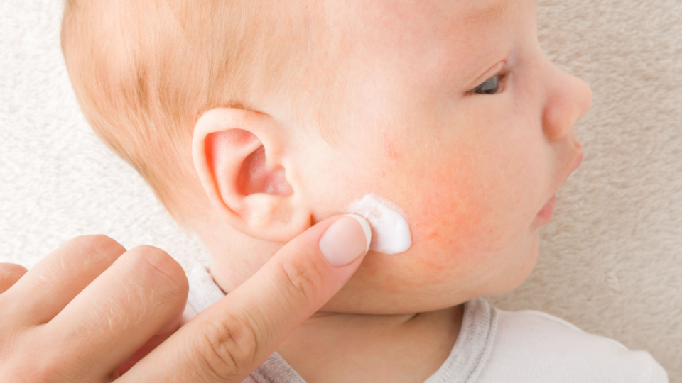 Baby Eczema: A Parent's Guide to Gentle, Natural Relief